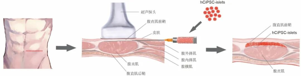 事關(guān)糖尿病治療，我國(guó)科學(xué)家取得突破